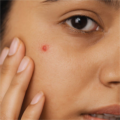 Acne Treatment Products