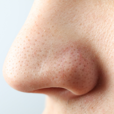 Black Heads