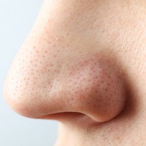 Blackheads